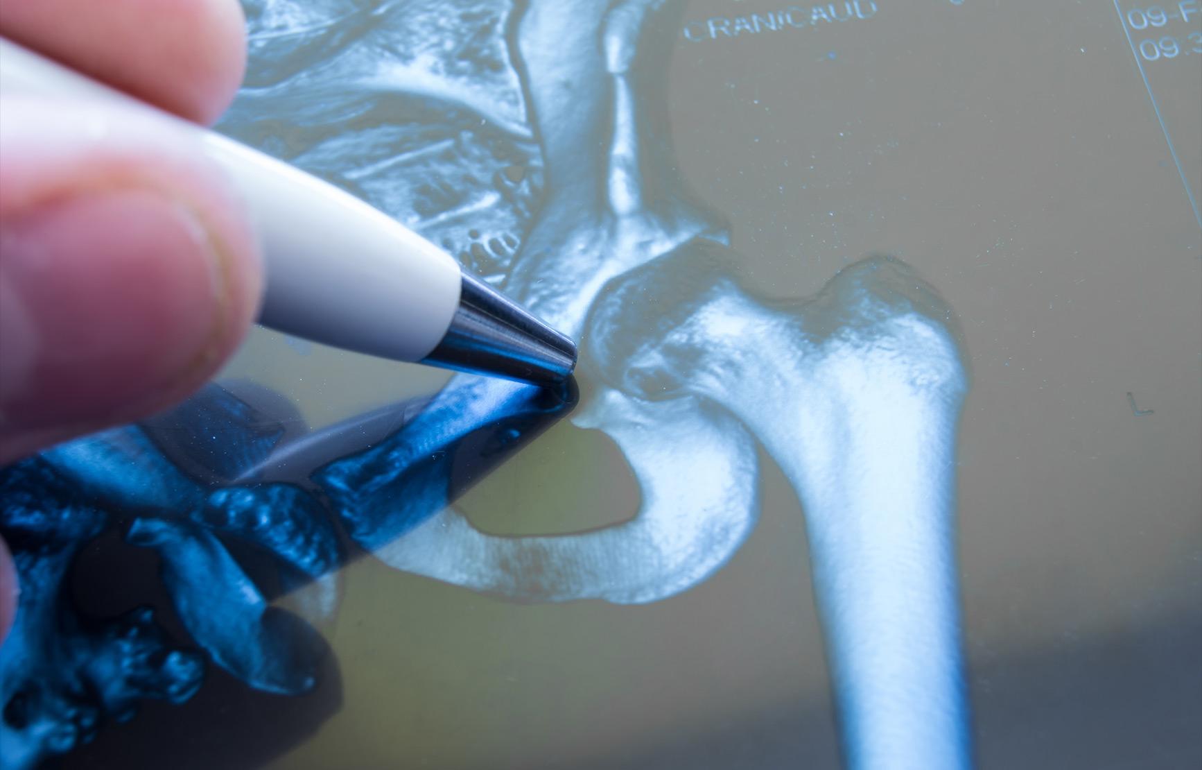 A hand pointing to a hip joint on an X-ray with a pen.